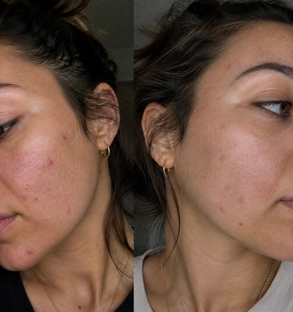 AnovàClair Advanced Full Coverage LED Mask